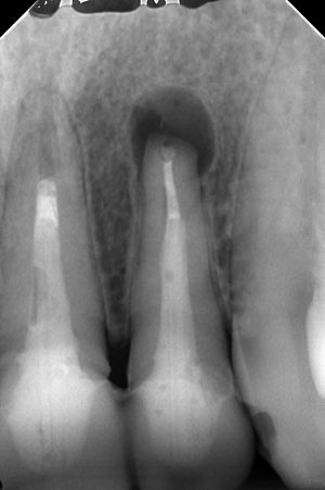 口蓋側（舌があるほう）に瘻孔（膿の出口）がある症例の外科をどうするか