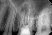根尖からオーバーした異物の経過2年（神経の管から古い素材が出ている症例）