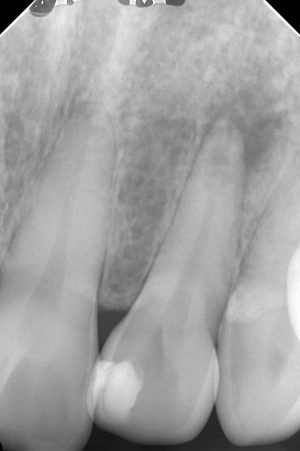 歯の内部吸収を伴う大きな病変に対してMTAを用いて治療した症例