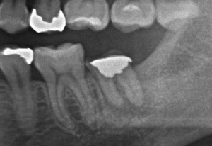 パーフォレーションを根管と誤認されていた症例