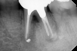 歯根端切除術後、分岐部が露出した症例のその後