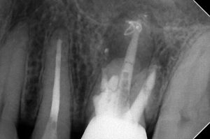 難易度の高かった歯根端切除術