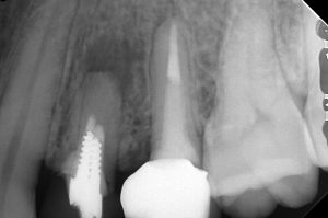 石灰化してしまった根管に歯根端切除を行った症例