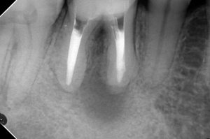 下顎右側大臼歯の歯根端切除術