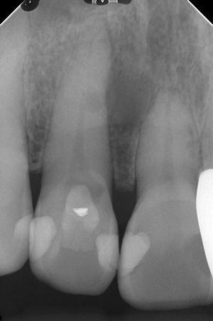 歯の内部吸収から大きな病変に至ってしまった歯の予後１８カ月