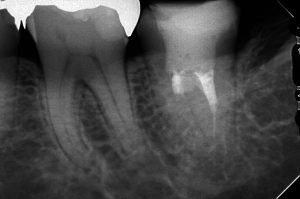 樋状根を有する歯の根管治療をどうするか