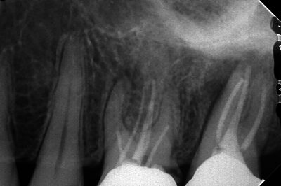 根管治療で治らない原因の一つ