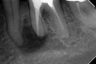 大きな病変が原因で隣の歯に影響が出てしまった症例