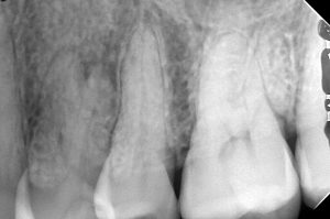 CTが非常に有用だった根管治療