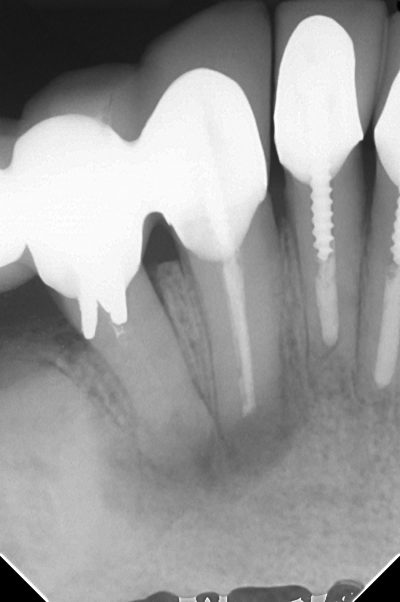 外科的歯内療法（歯根端切除術）について