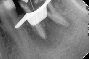 大きな穿孔（パーフォレーション）を有する歯の根管治療