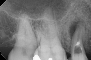 根管治療を行った歯は歯根破折を起こしやすい