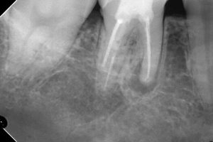 根尖が壊れていて、大きな病変を有する歯のその後