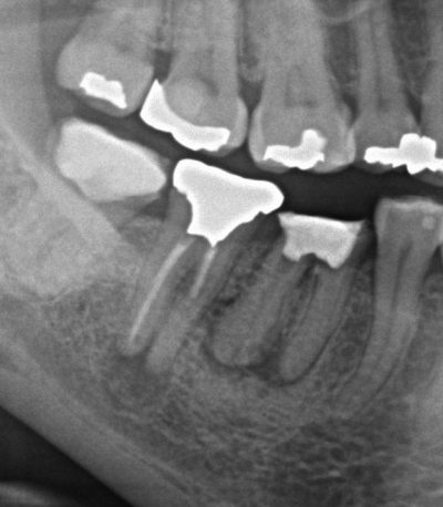インプラントVS歯の移植