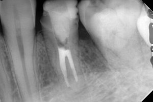 下顎小臼歯の根管治療は意外と難しい