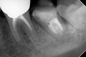 外科的歯内療法（意図的再植）を計画するも、破折に気づき移植に術式を変更したケース