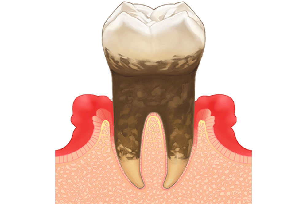 歯周病の悪化