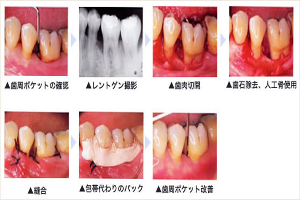 重度歯周病治療に対応