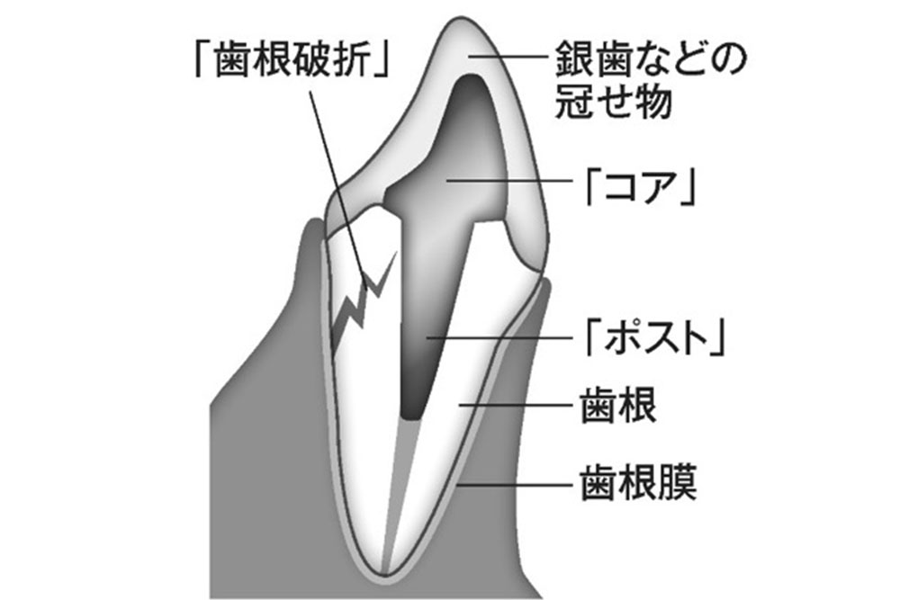 メタルコア