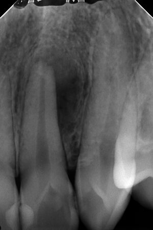 大きな病変を有する歯の根管治療