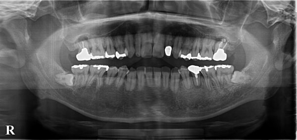 1年半、通院が途絶えた大きな病変を有する歯のその後