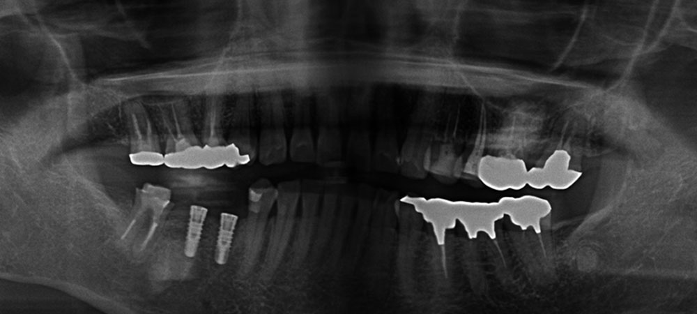 インプラント埋入後のレントゲン
