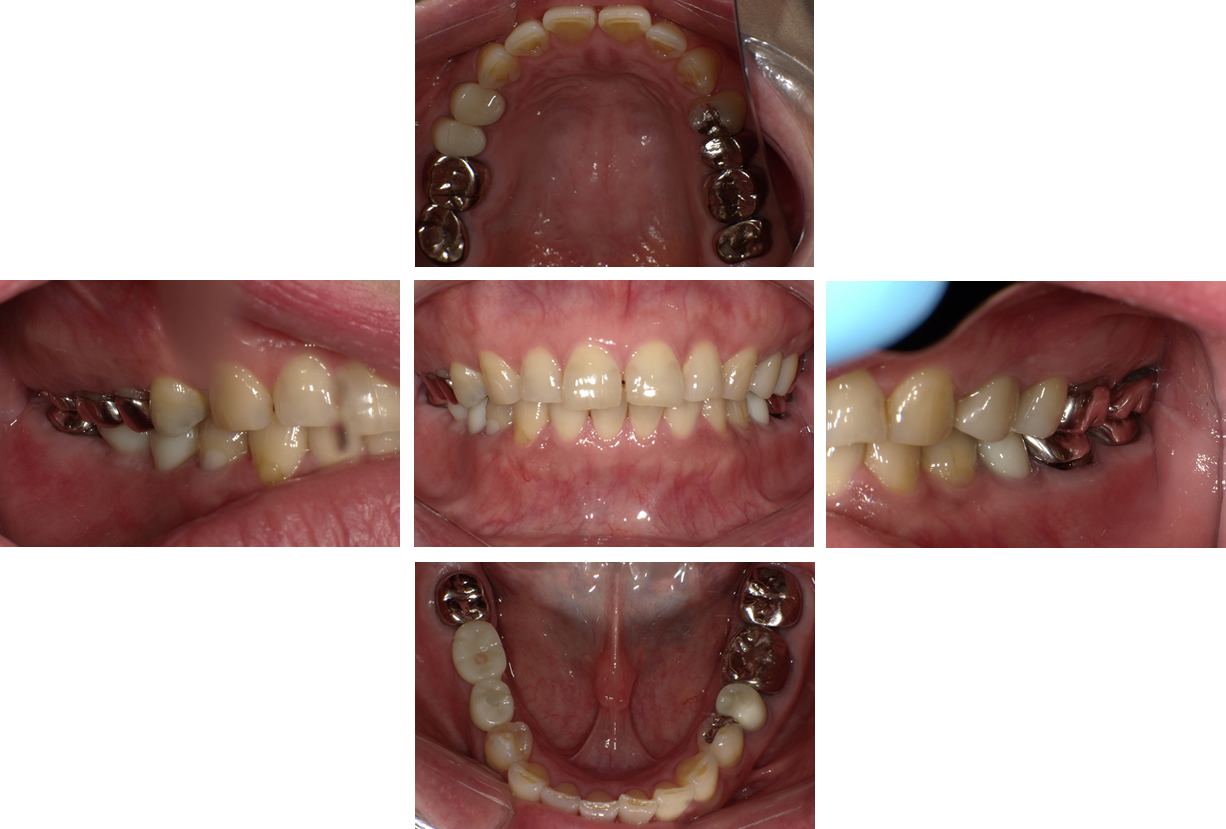 セミラック歯を被せて治療完了