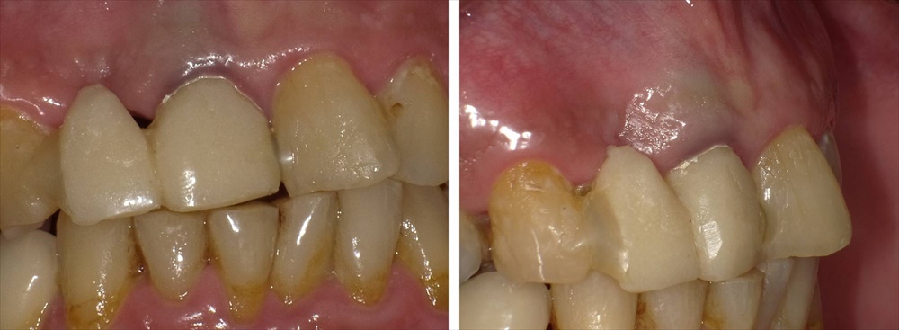 難易度の高い前歯部インプラント症例