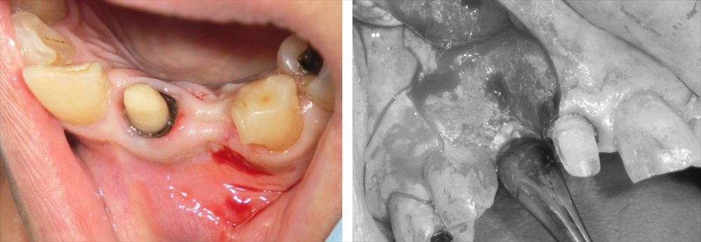 難易度の高い前歯部インプラント症例