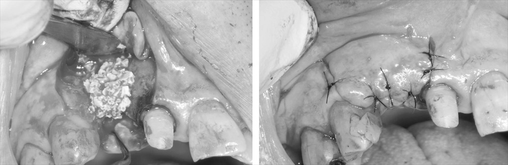難易度の高い前歯部インプラント症例