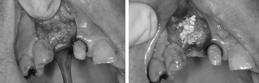 難易度の高い前歯部インプラント症例