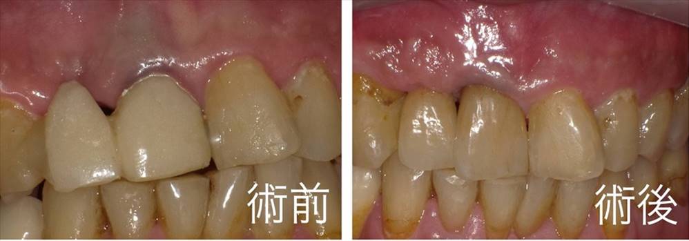 難易度の高い前歯部インプラント症例