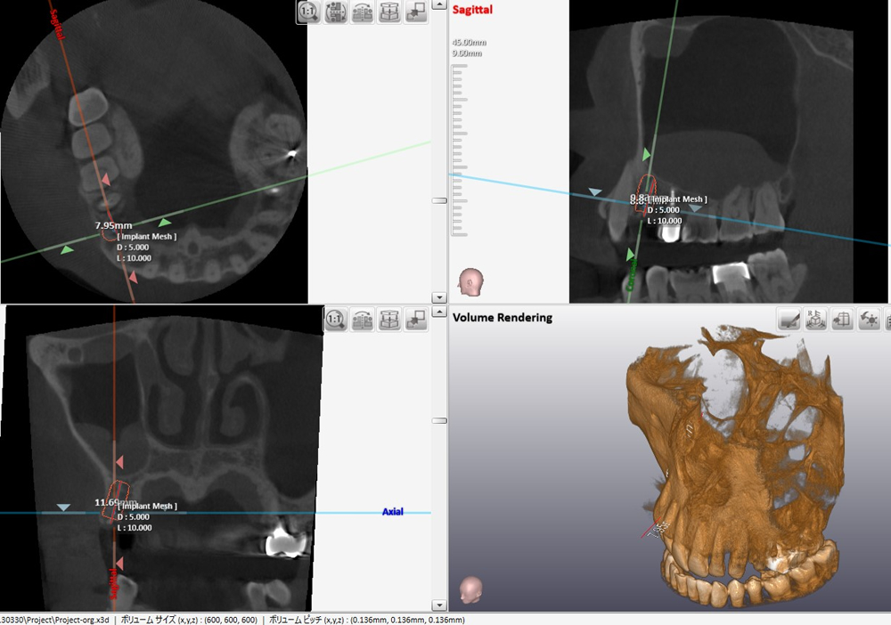 CTによるインプラント埋入ポジション確認