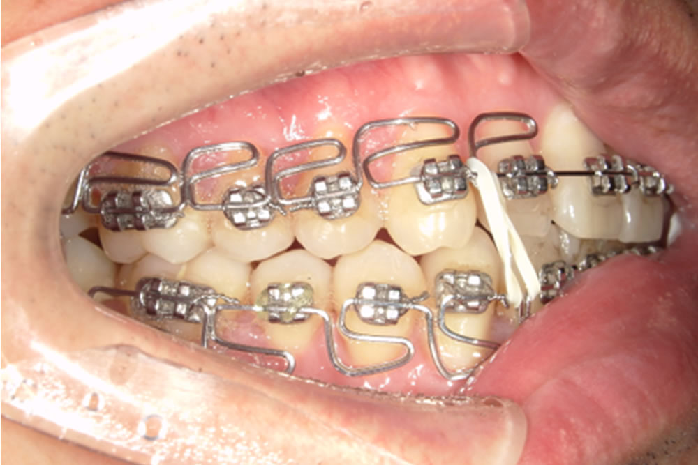 MEAW（ミョー）矯正