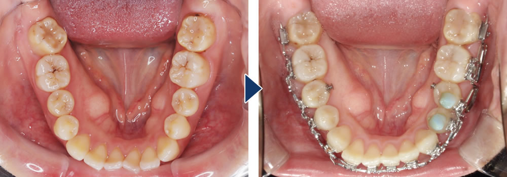 MEAW(ミョー)矯正