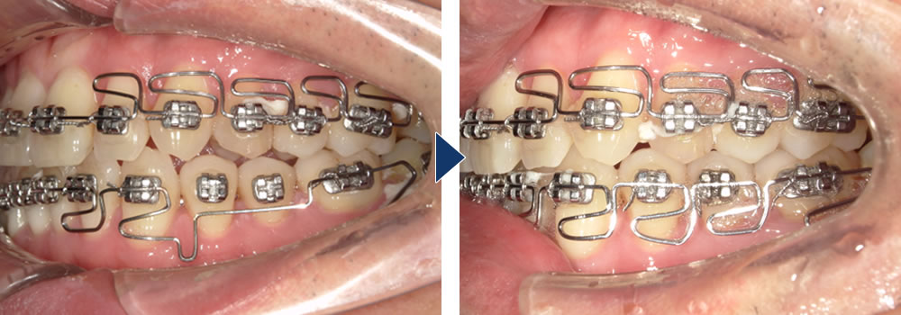 MEAW(ミョー)矯正