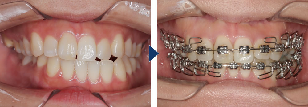 MEAW(ミョー)矯正