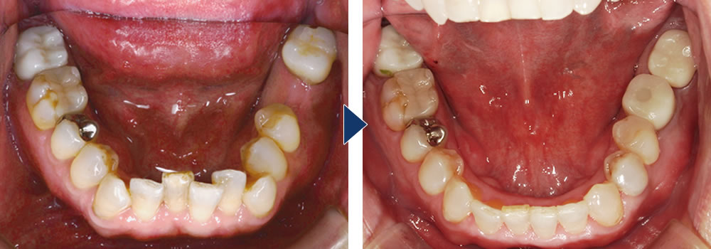 MEAW(ミョー)矯正