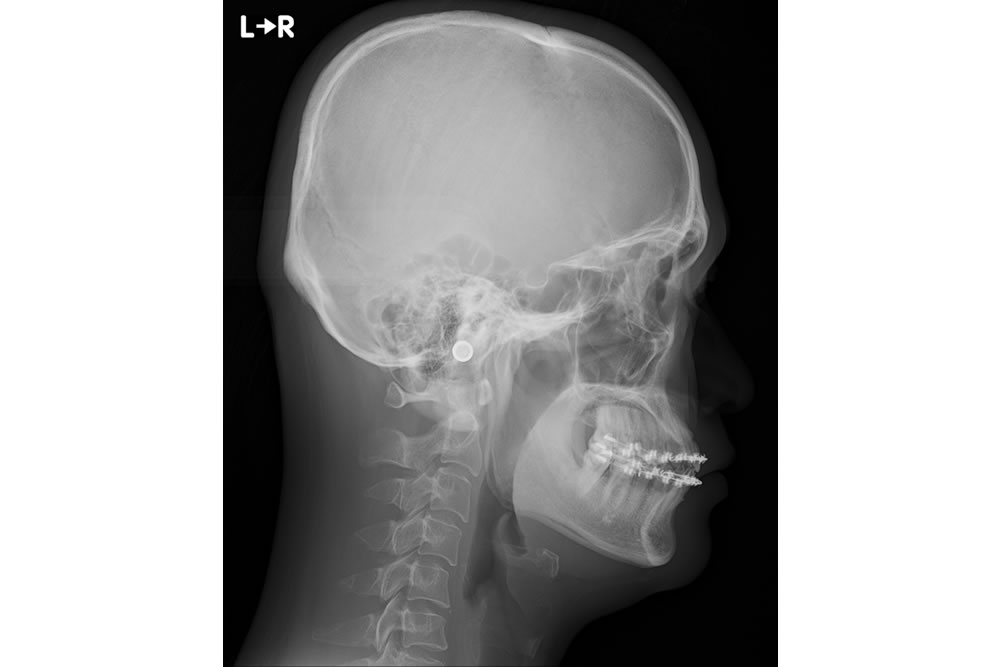 セファロレントゲン