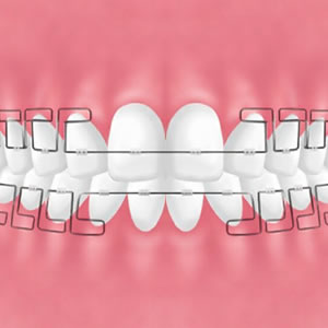MEAWを用いた矯正治療