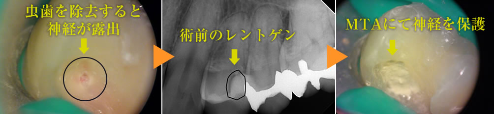 MTAによるパーフォレーションの治療例