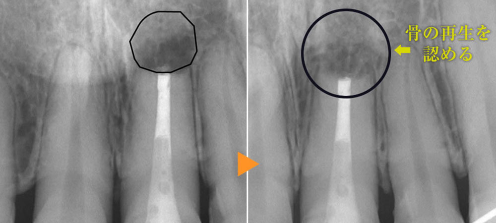 MTAによる外科的歯内療法の治療例