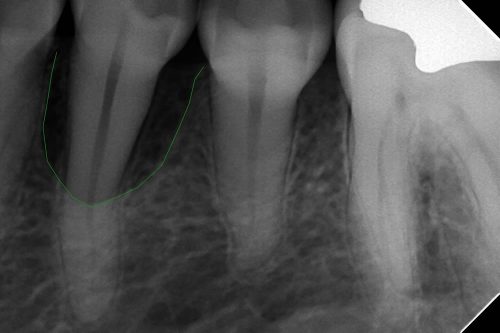 歯周病で歯が動揺する